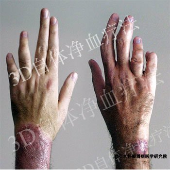 手部银屑病的致病因素有哪些