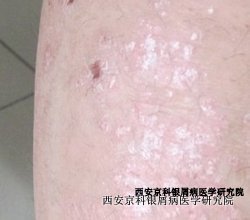怎样辨别是否患牛皮癣