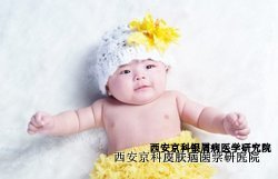 儿童牛皮癣是怎样造成的