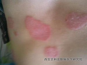 生活中应怎样辨别银屑病症状