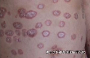 治疗中老年前期银屑病的要素