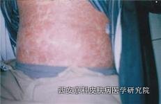 治疗青少年银屑病该注意哪些事
