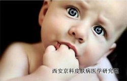 儿童银屑病治疗应注意哪些事项