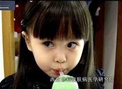 小孩得了银屑病怎么治疗