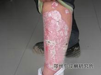 郑州哪个医院看牛皮癣看的好