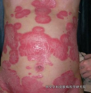怎样才能预防牛皮癣扩散