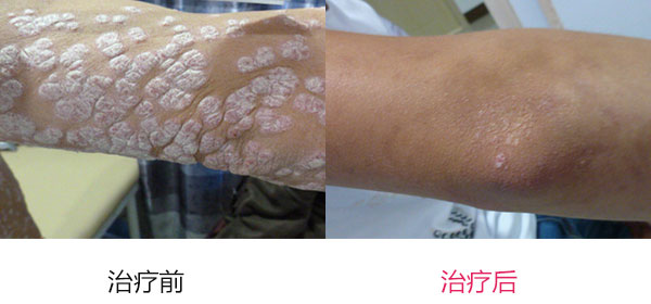 牛皮癣日常护理有哪些