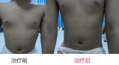 牛皮癣该如何预防
