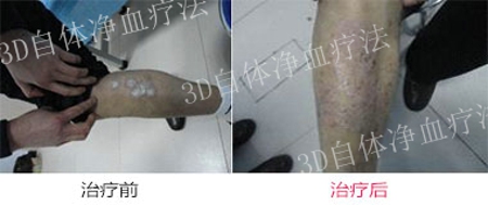 诱发青少年牛皮癣发病的原因是什么