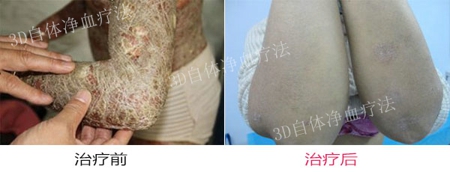 牛皮癣常见病因是什么