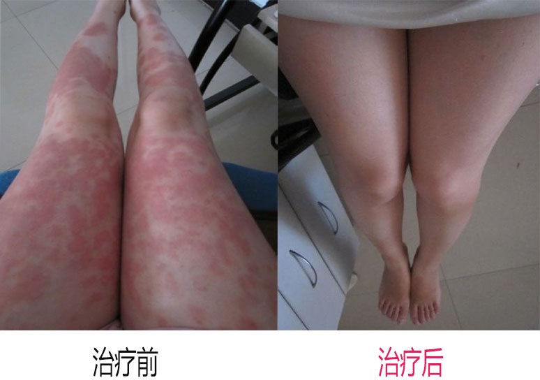 银屑病治疗什么方法最好