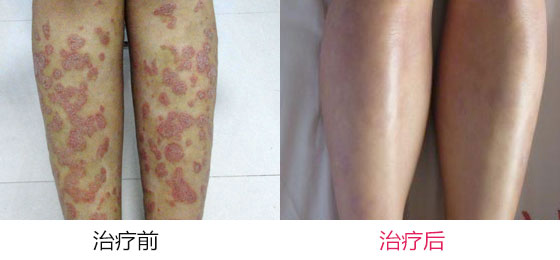 儿童牛皮癣病因是什么