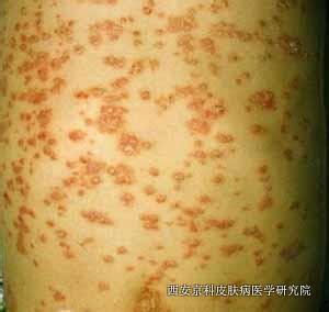 银屑病的病因是什么