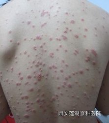 银屑病怎么治疗